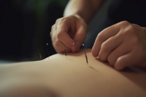 close-up-of-acupuncture-needles-inserted-into-skin